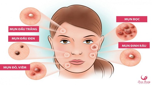 Mụn là một rối loạn phát sinh từ hoạt động các hormone