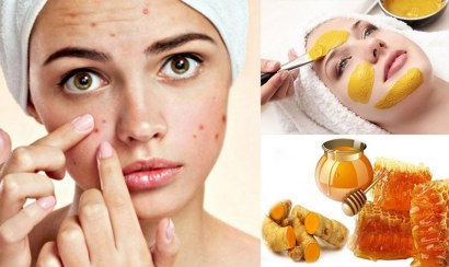 Bí quyết trị mụn bằng mật ong